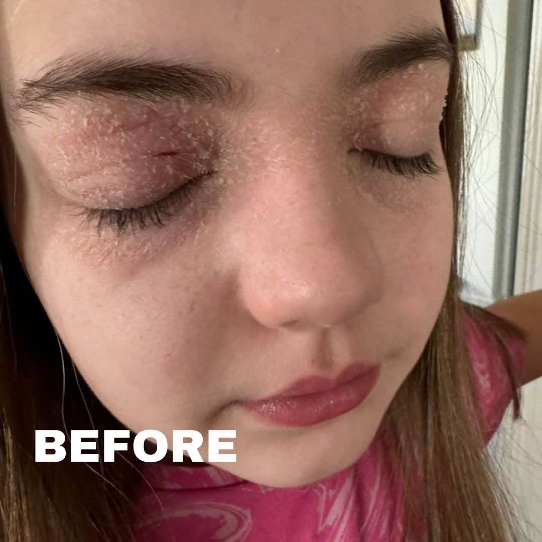 Eyelid eczema or Blepharitis