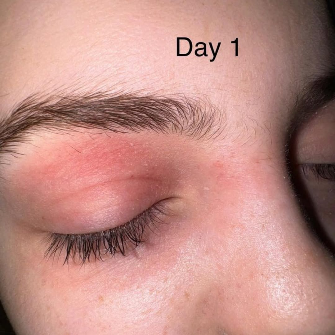 eyelid eczema photo
