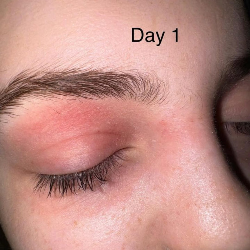 Eyelid Eczema vs Contact Dermatitis