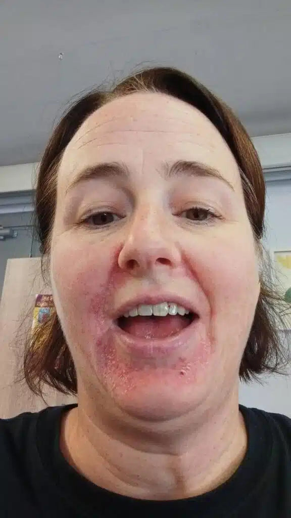 lorraine with perioral dermatitis on her chin