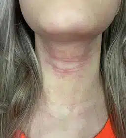 Best Moisturiser for Skin Rash: Why Bragan Skincare’s Atopic Cream is Your Ideal Solution