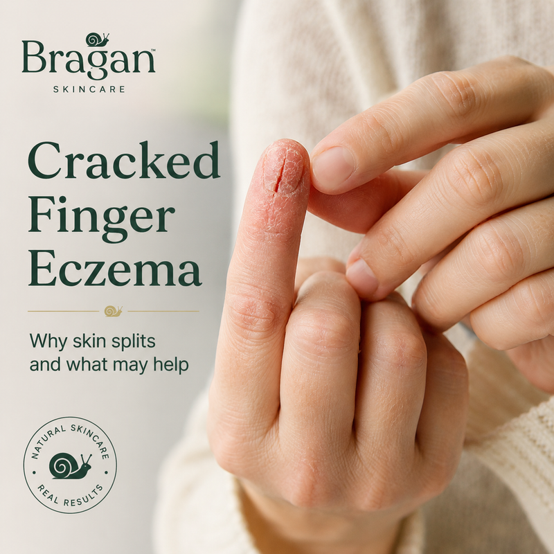 Cracked Finger Eczema: Why Skin Splits and What May Help