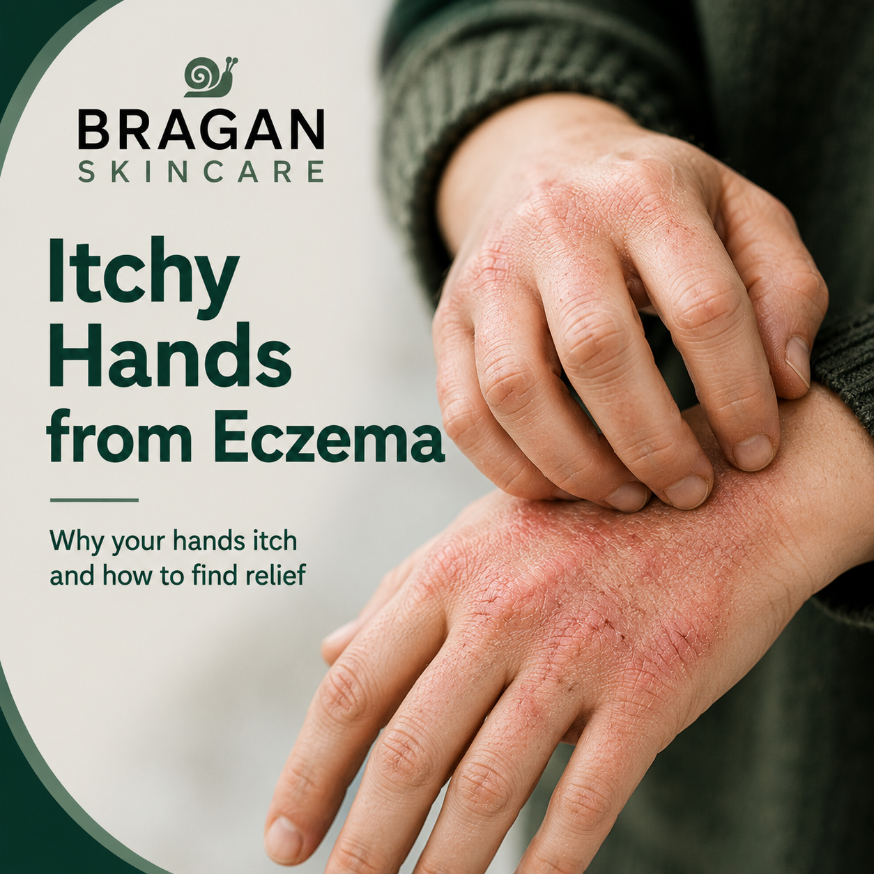 Close-up of a person gently scratching dry, red hands affected by hand eczema, illustrating persistent itching caused by skin barrier damage and inflammation.