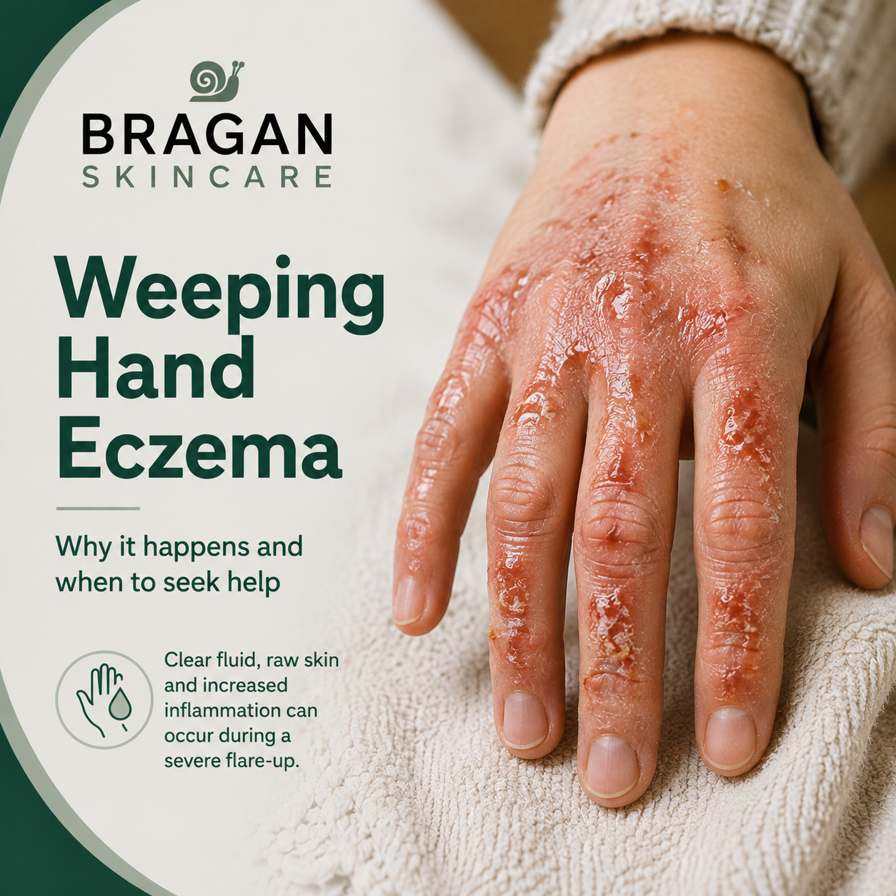 Close-up of a hand with severe weeping hand eczema showing inflamed, moist skin and areas of crusting on the fingers and back of the hand, illustrating an active eczema flare-up.