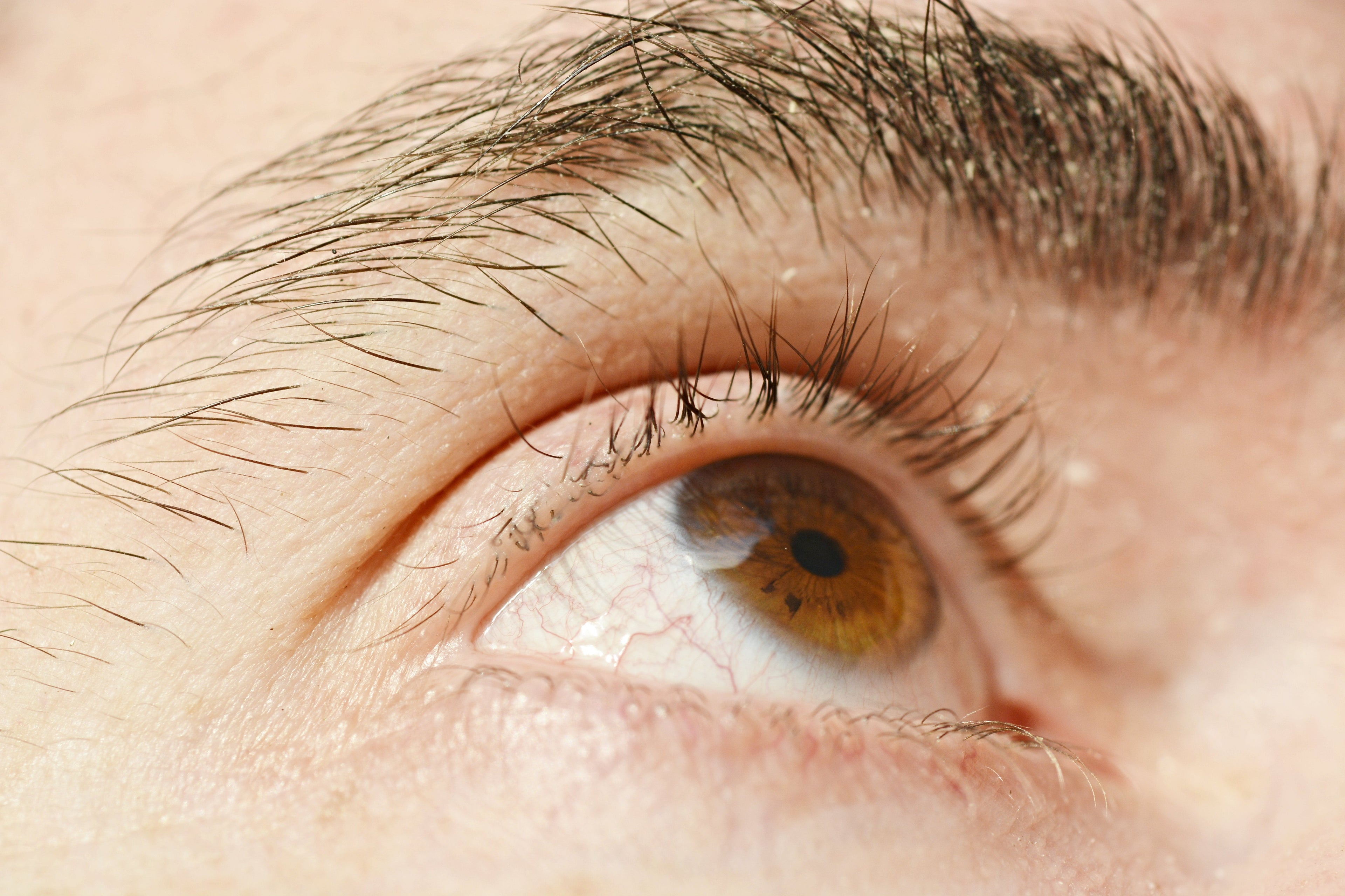 dry eyelid or eczema