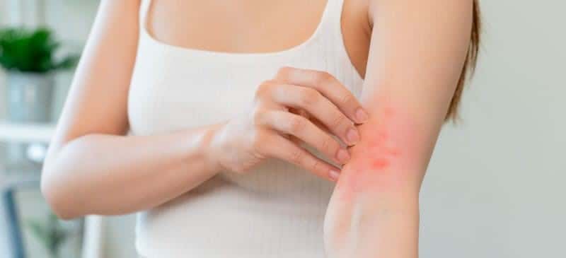 lady applying bragan atopic cream to eczema on her arm