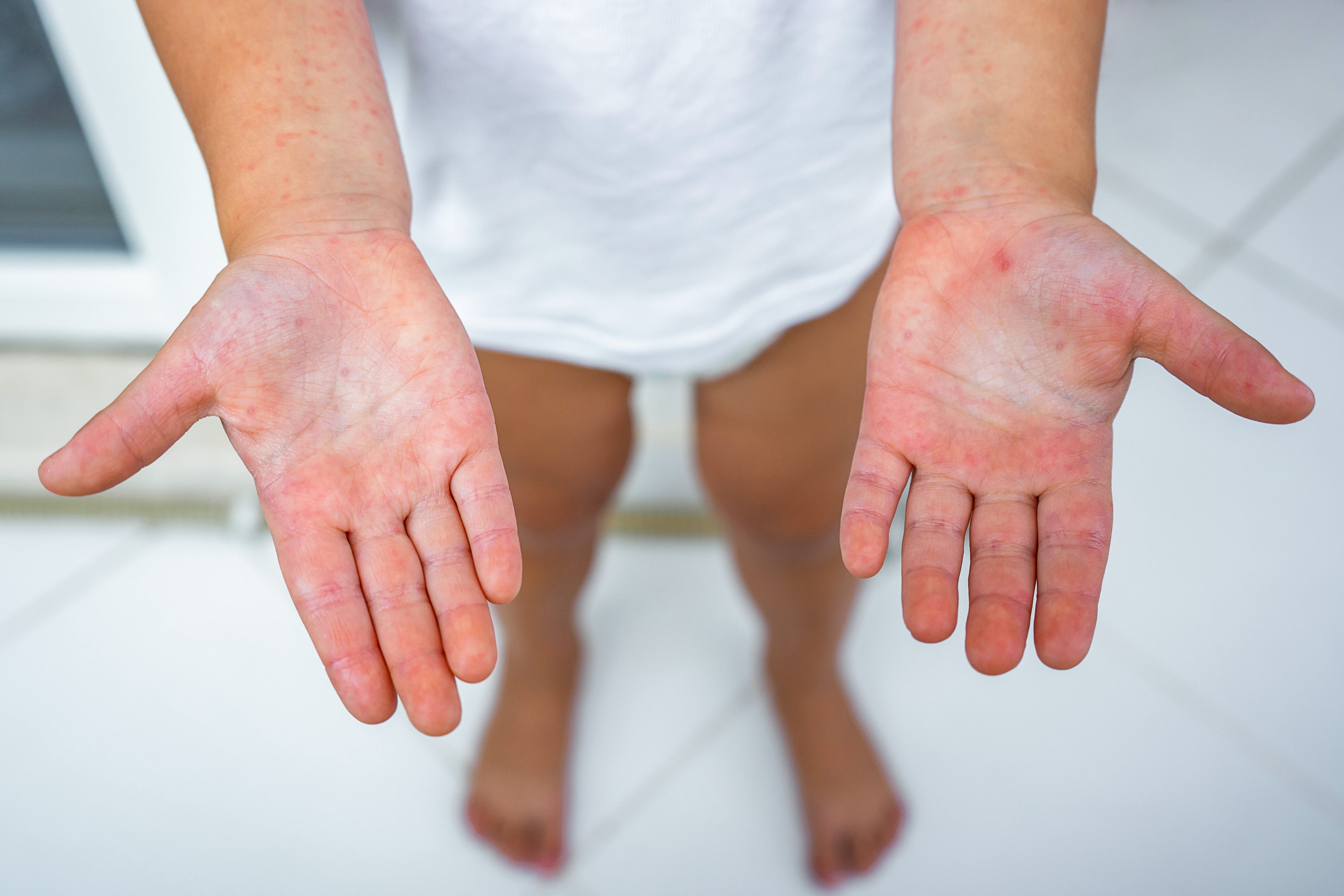 eczema on the hands