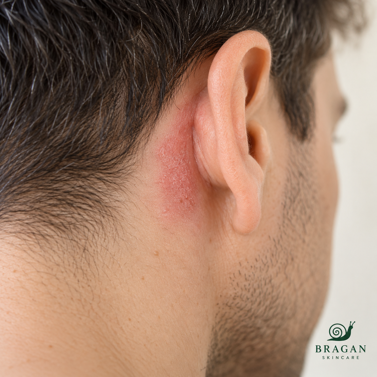 Close-up of a red, mildly flaky patch of skin behind a man’s ear.