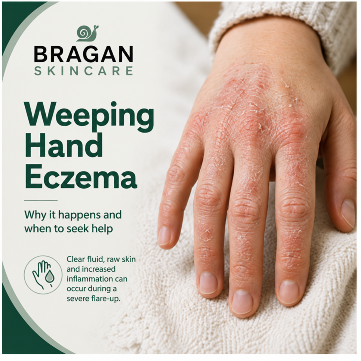 Bragan Skincare guide to weeping hand eczema showing a mildly red, dry and irritated hand.