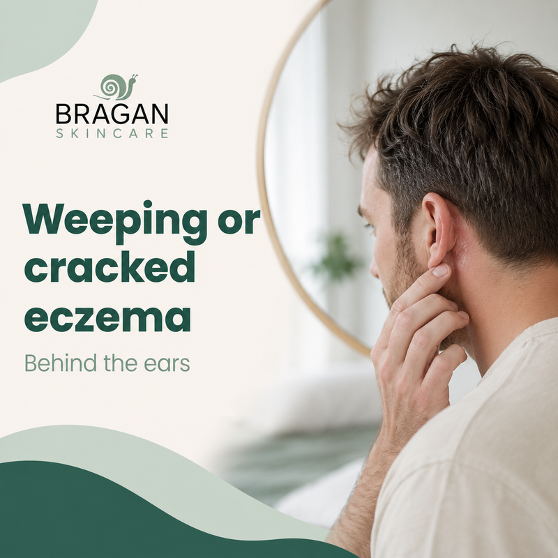 Weeping or cracked eczema behind the ears: Relief