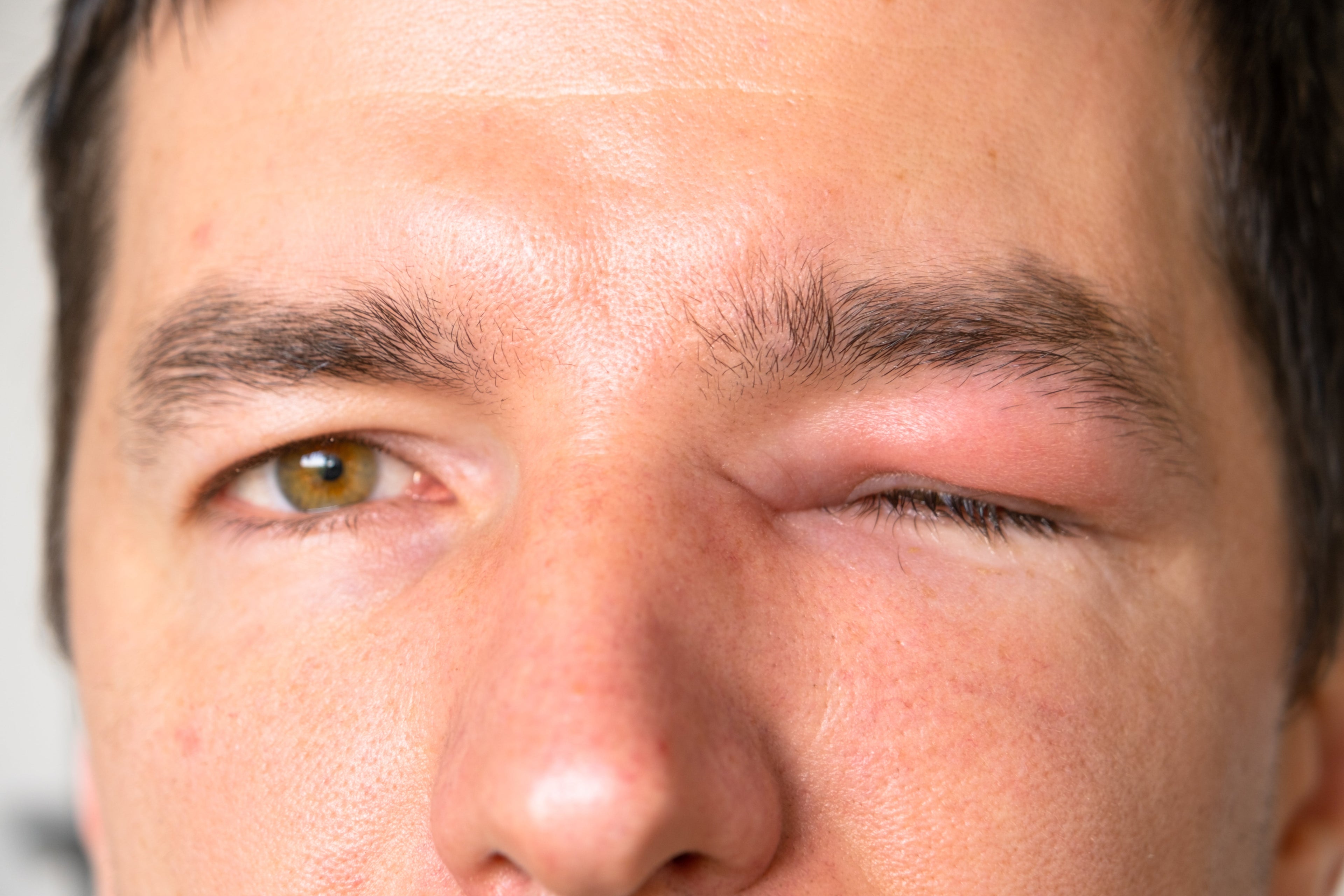 man with eyelid eczema