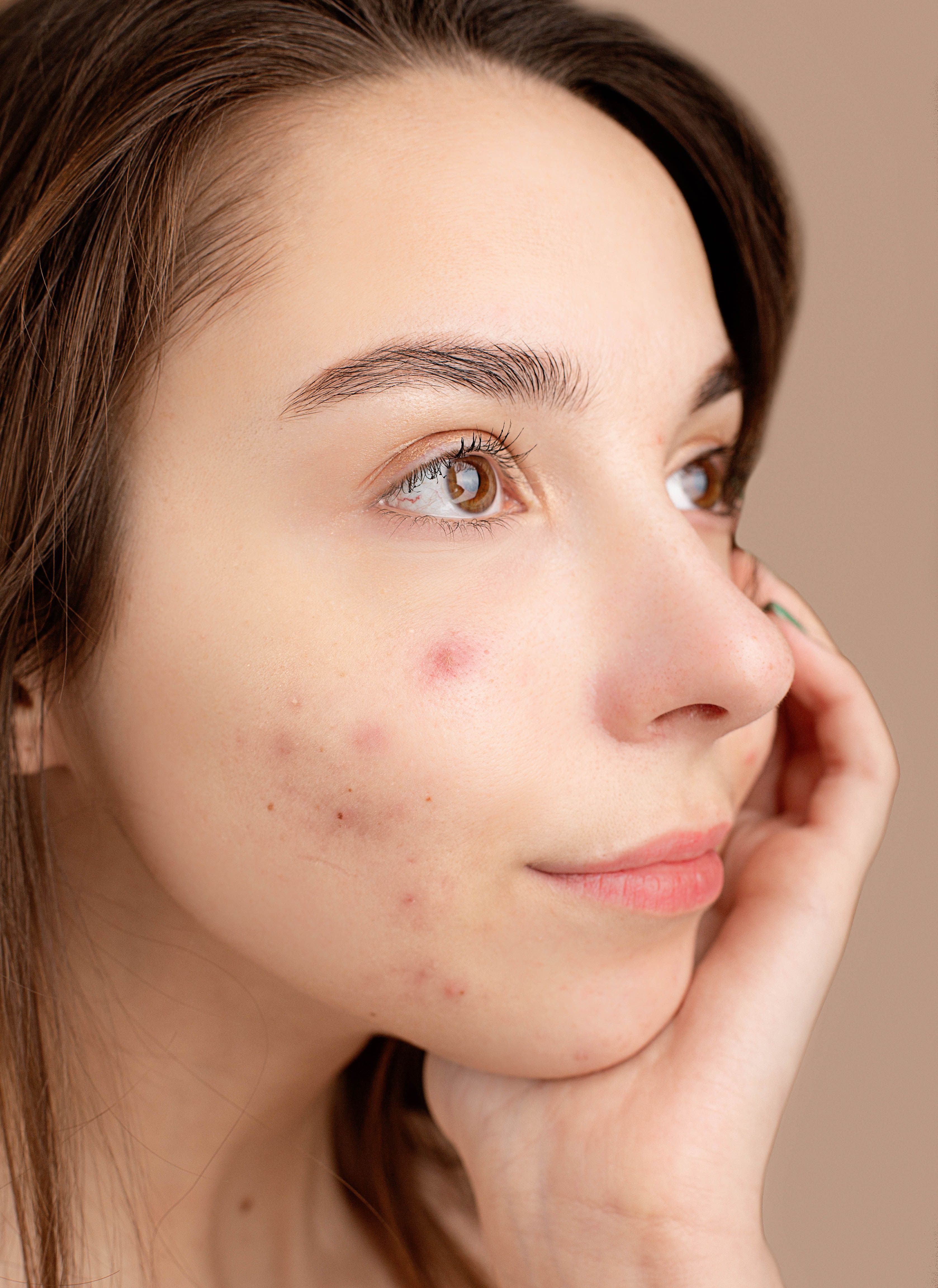 Close-up of facial skin with visible bumps that could have several possible causes.
