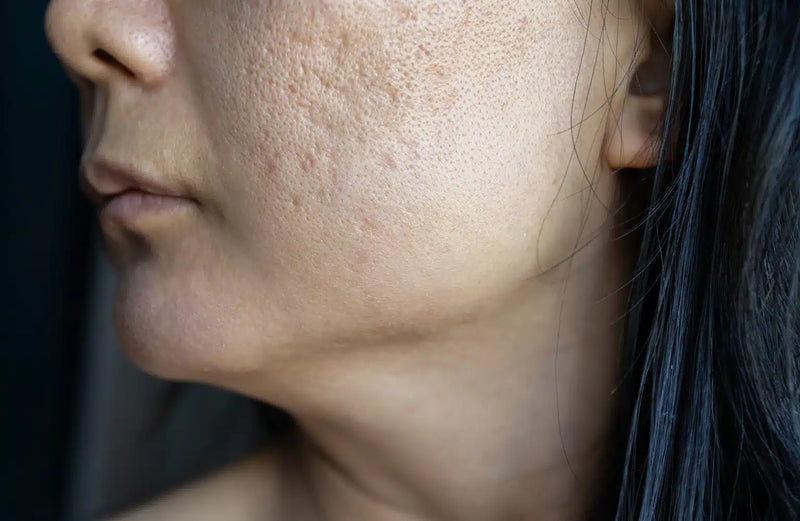 Is Snail Slime Good for Acne