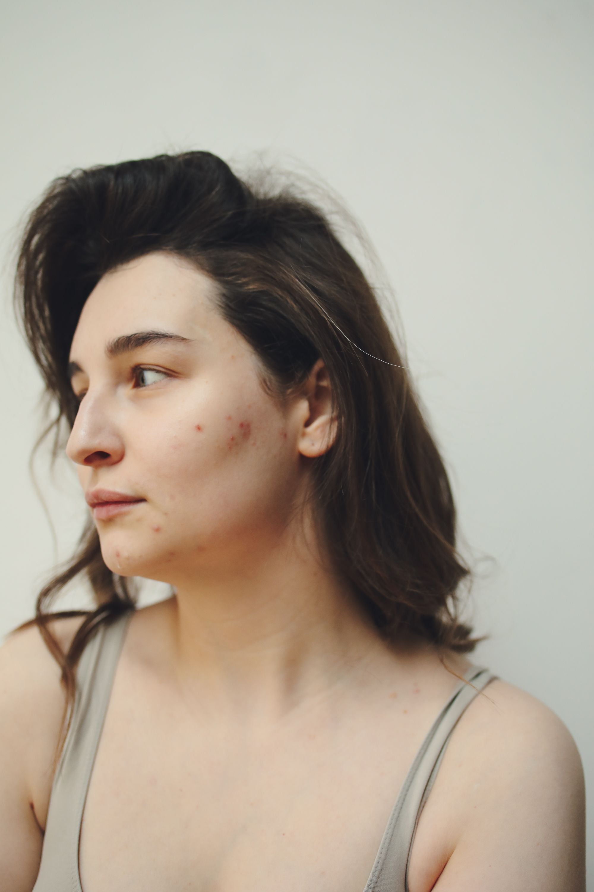 Close-up of facial skin showing visible acne symptoms and mild inflammatory breakouts.