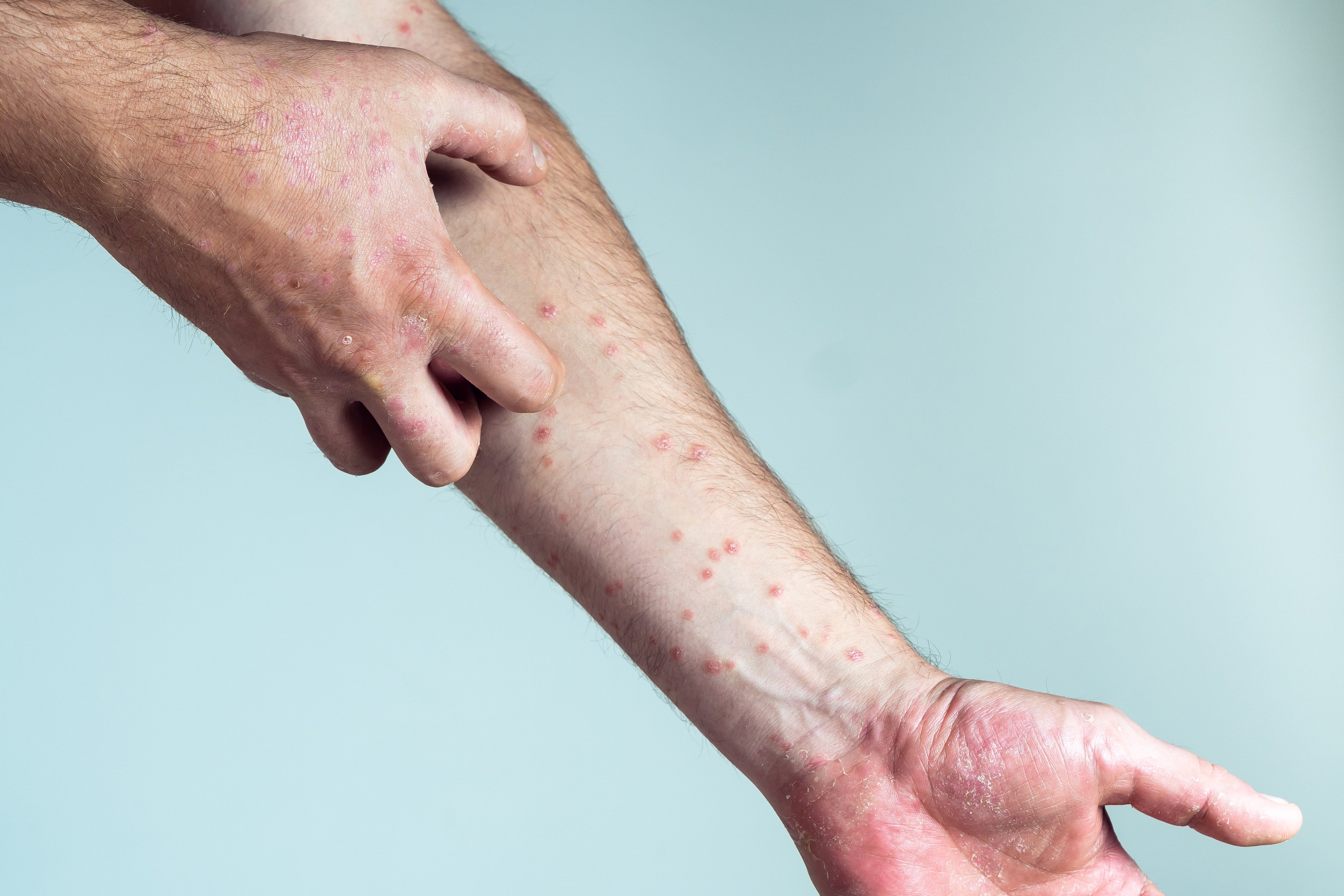 a rash on a man's arm spreading upwards