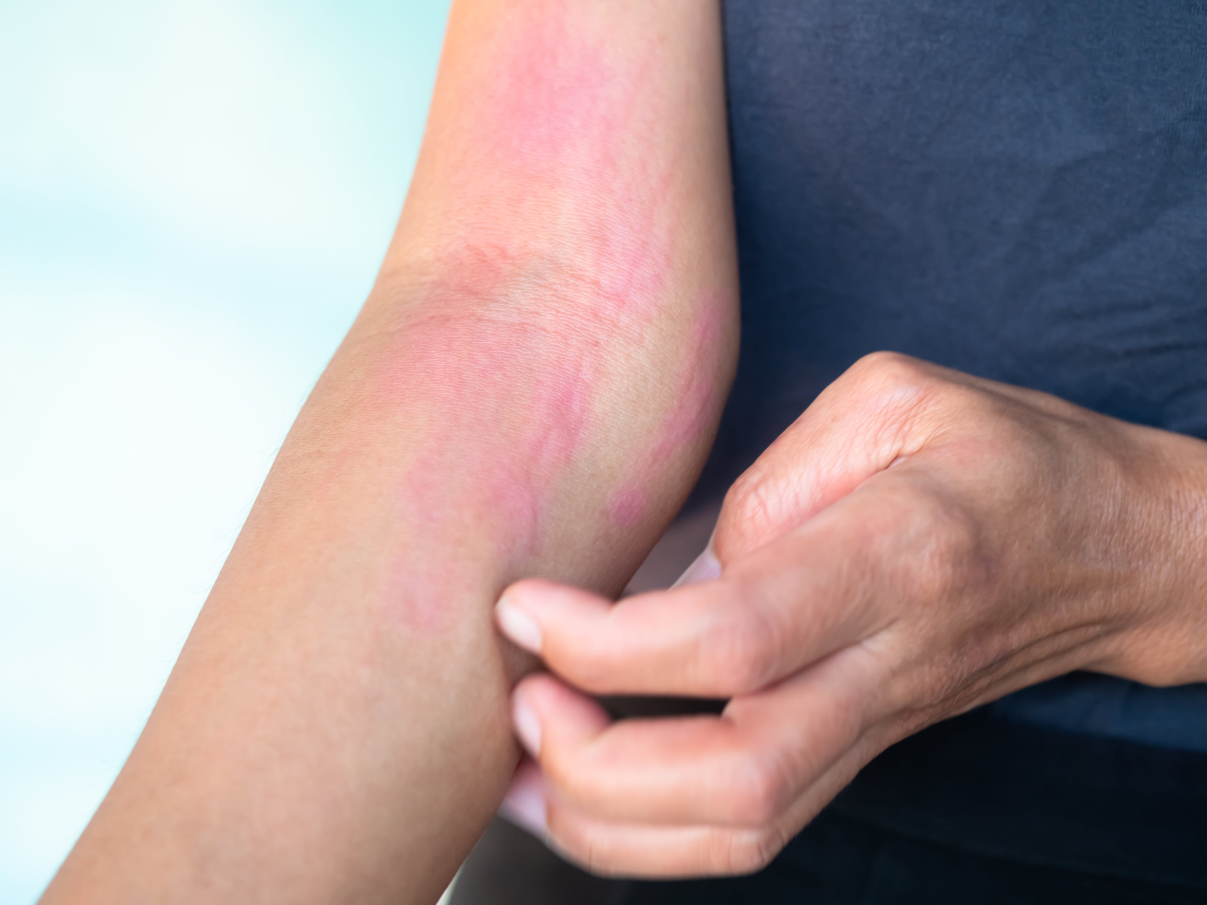 allergic reation on the arm