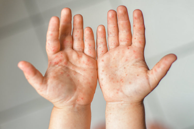 Small Blisters On Hands: Causes, Symptoms &amp; Treatment