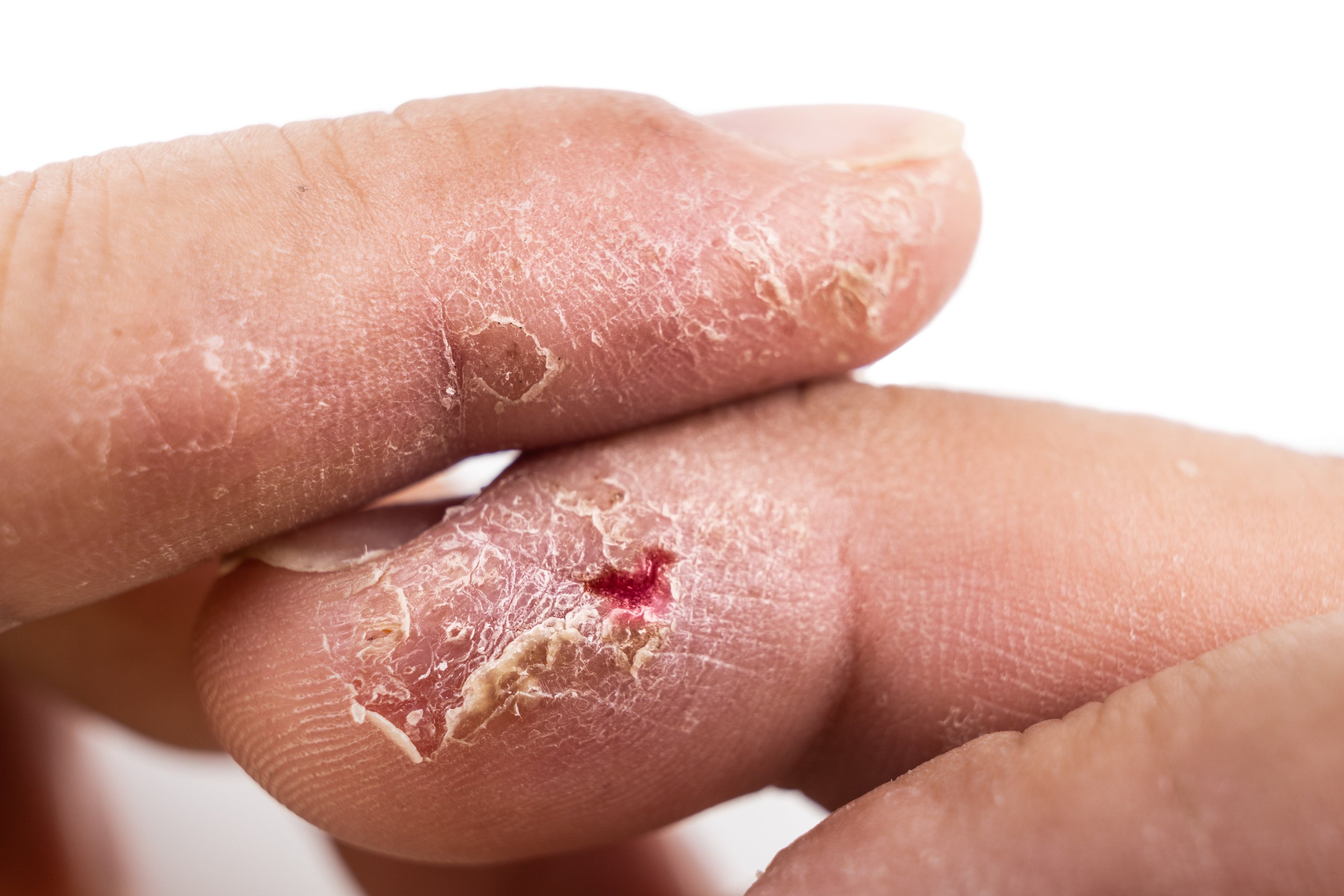 dermatitis blisters on fingers