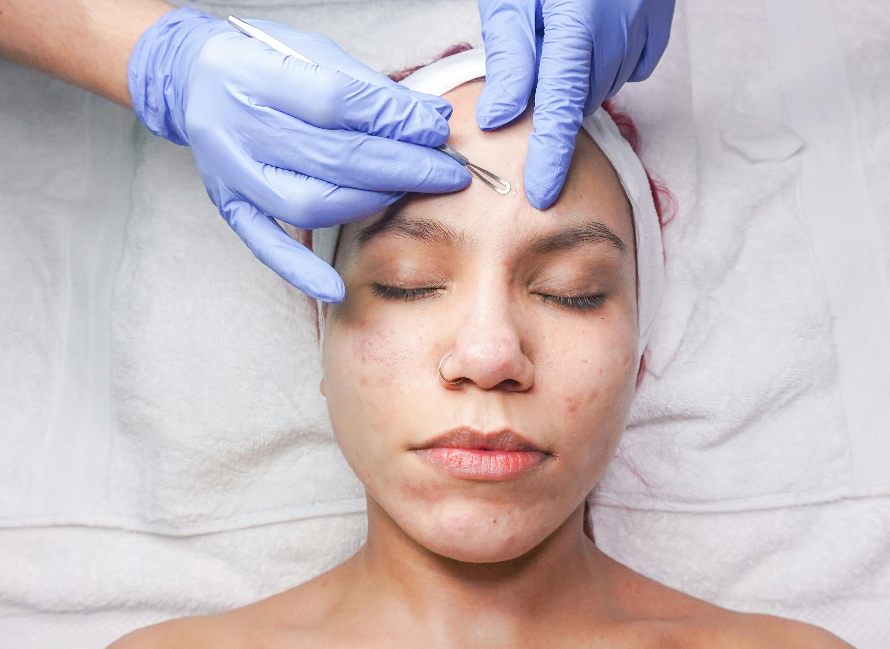 Bragan Skincare woman suffering from acne symptoms