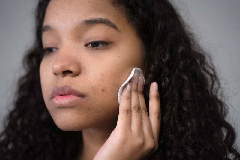 Acne Treatments: A Complete Guide to Managing and Treating Acne