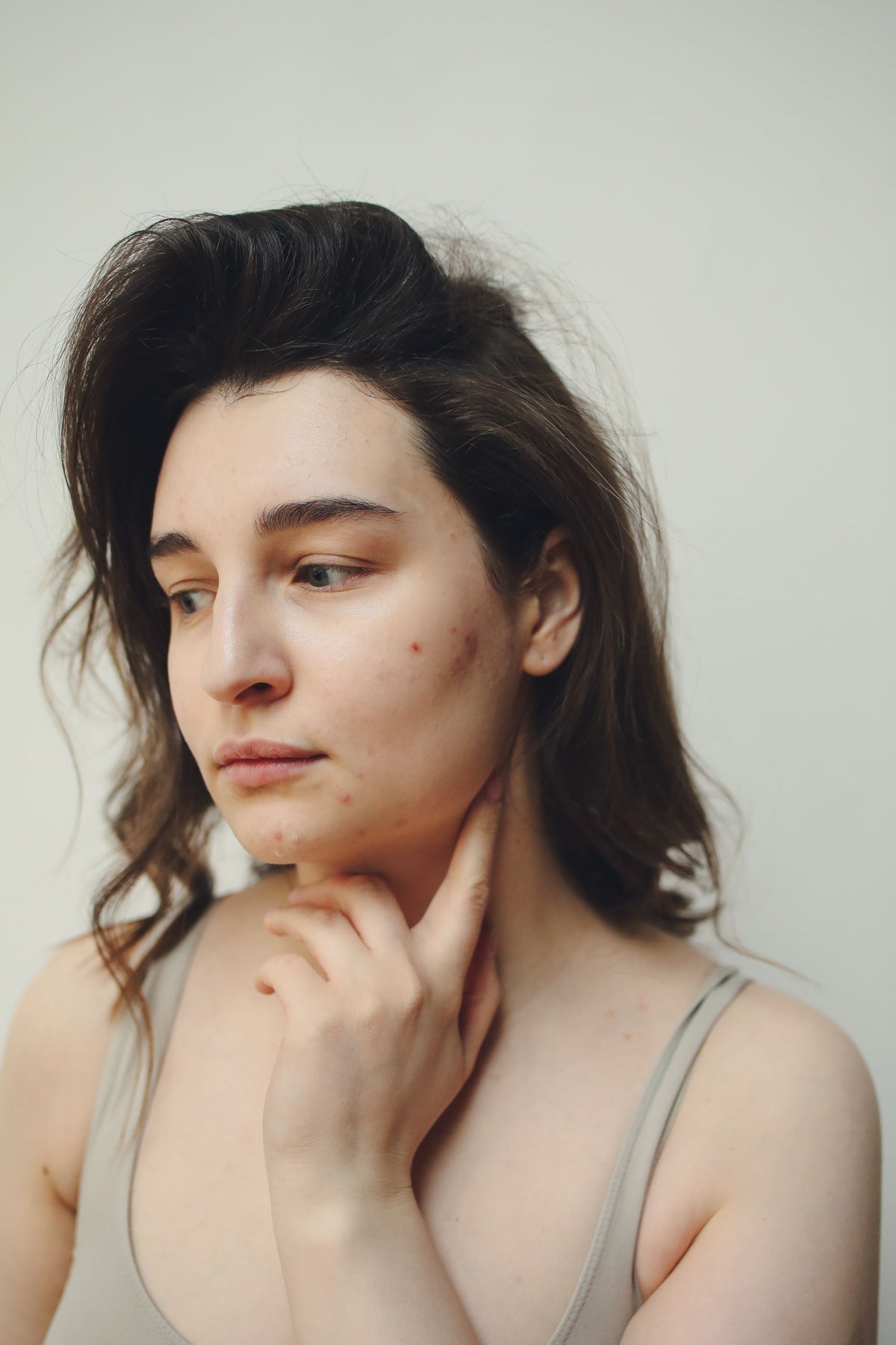 Woman looking at hormonal acne breakouts around her lower face in a mirror.