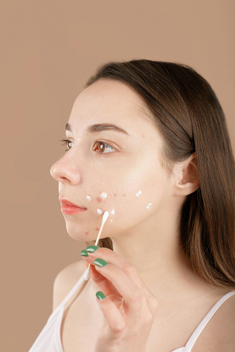 What Causes Acne? Understanding the Real Reasons Behind Breakouts