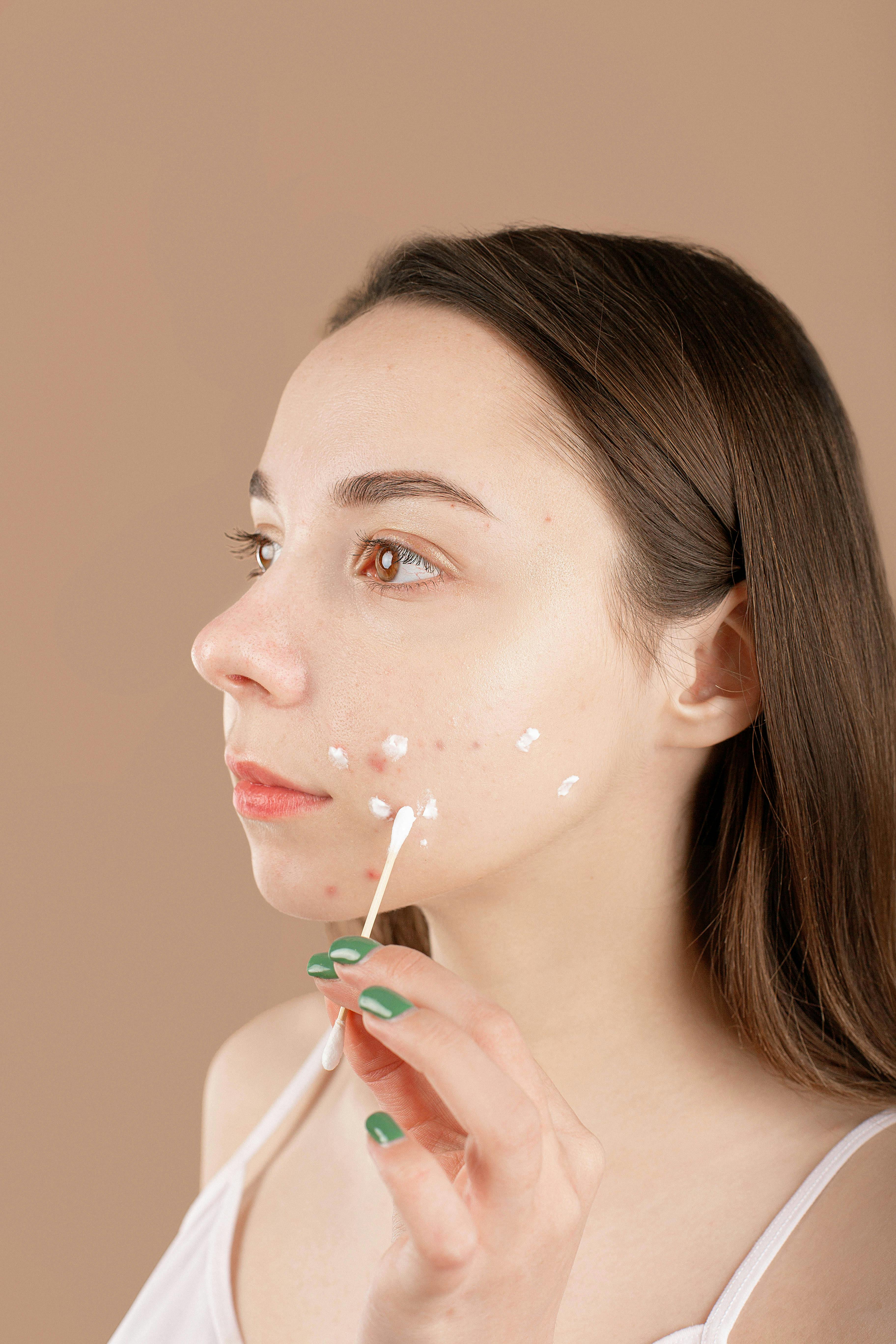 woman applying treatment cream to acne on face