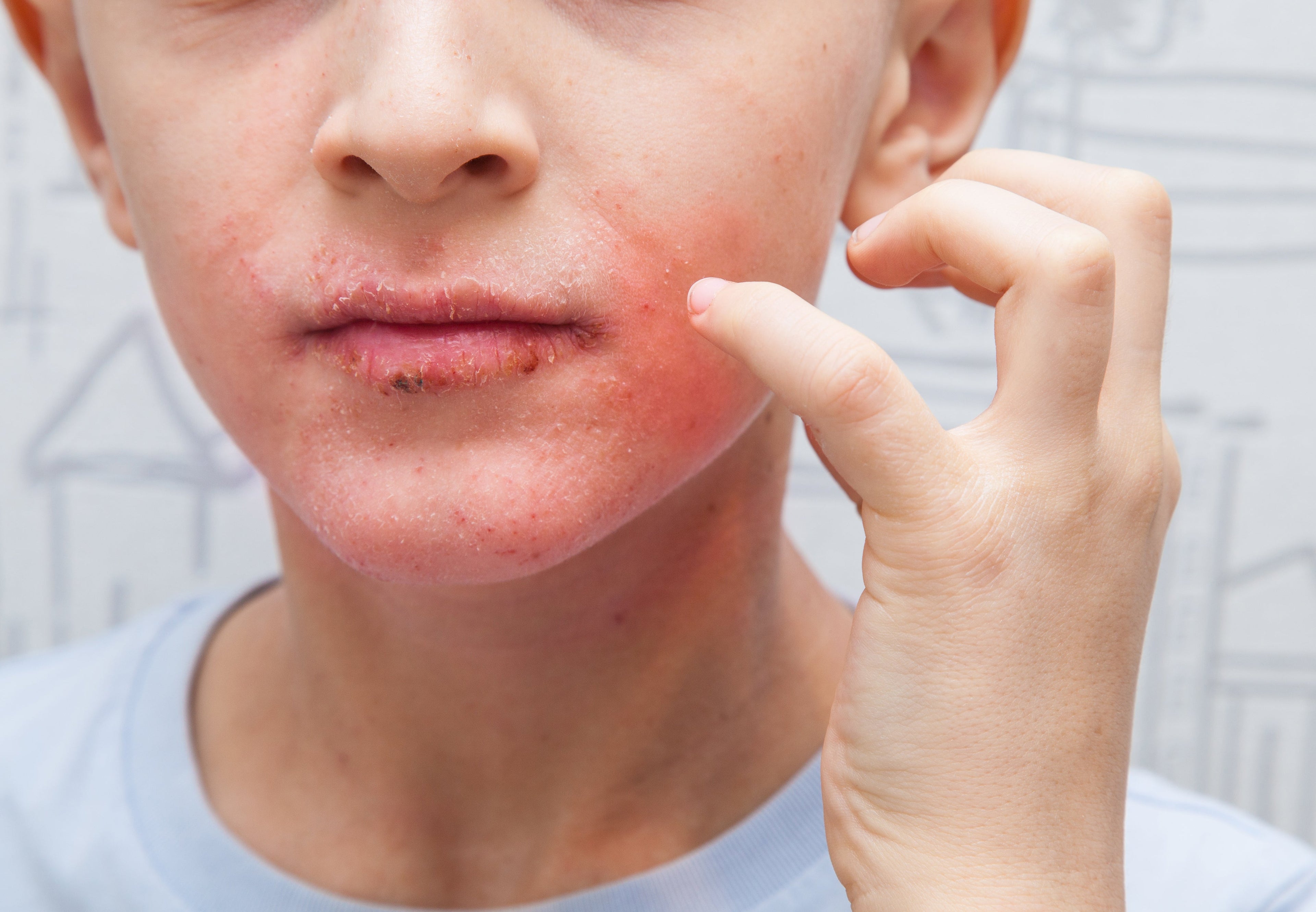 irirated facial skin