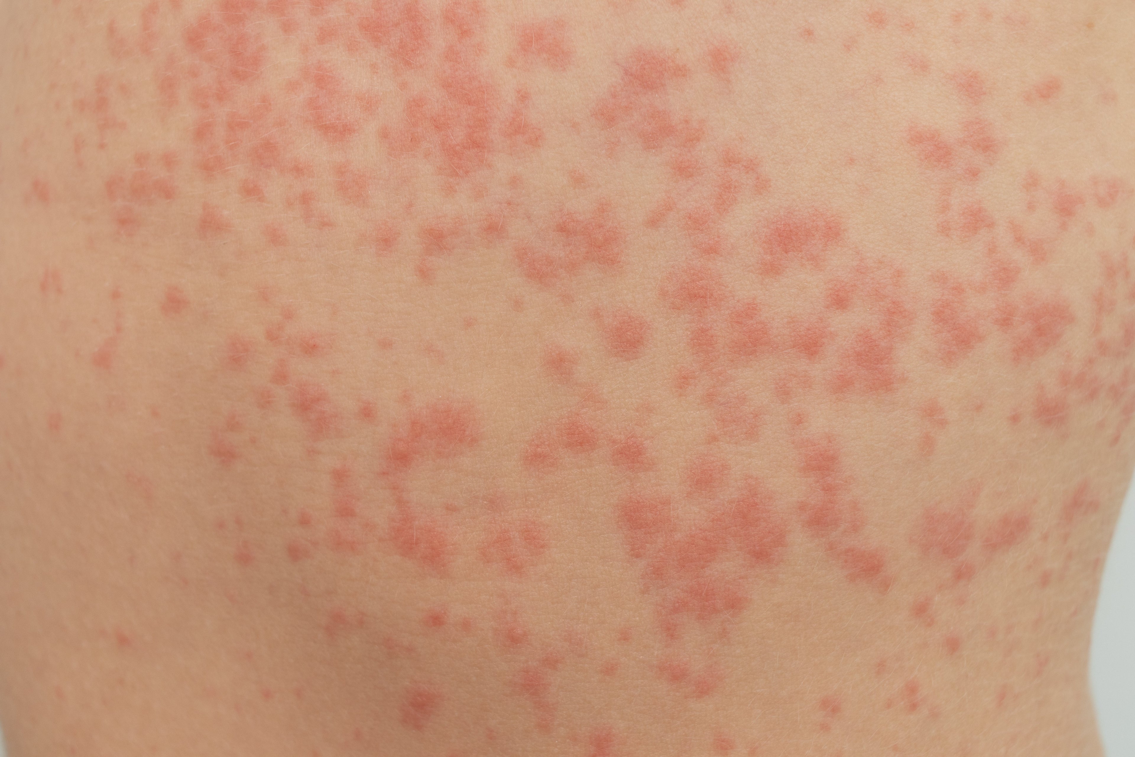 heat rash on someone's skin