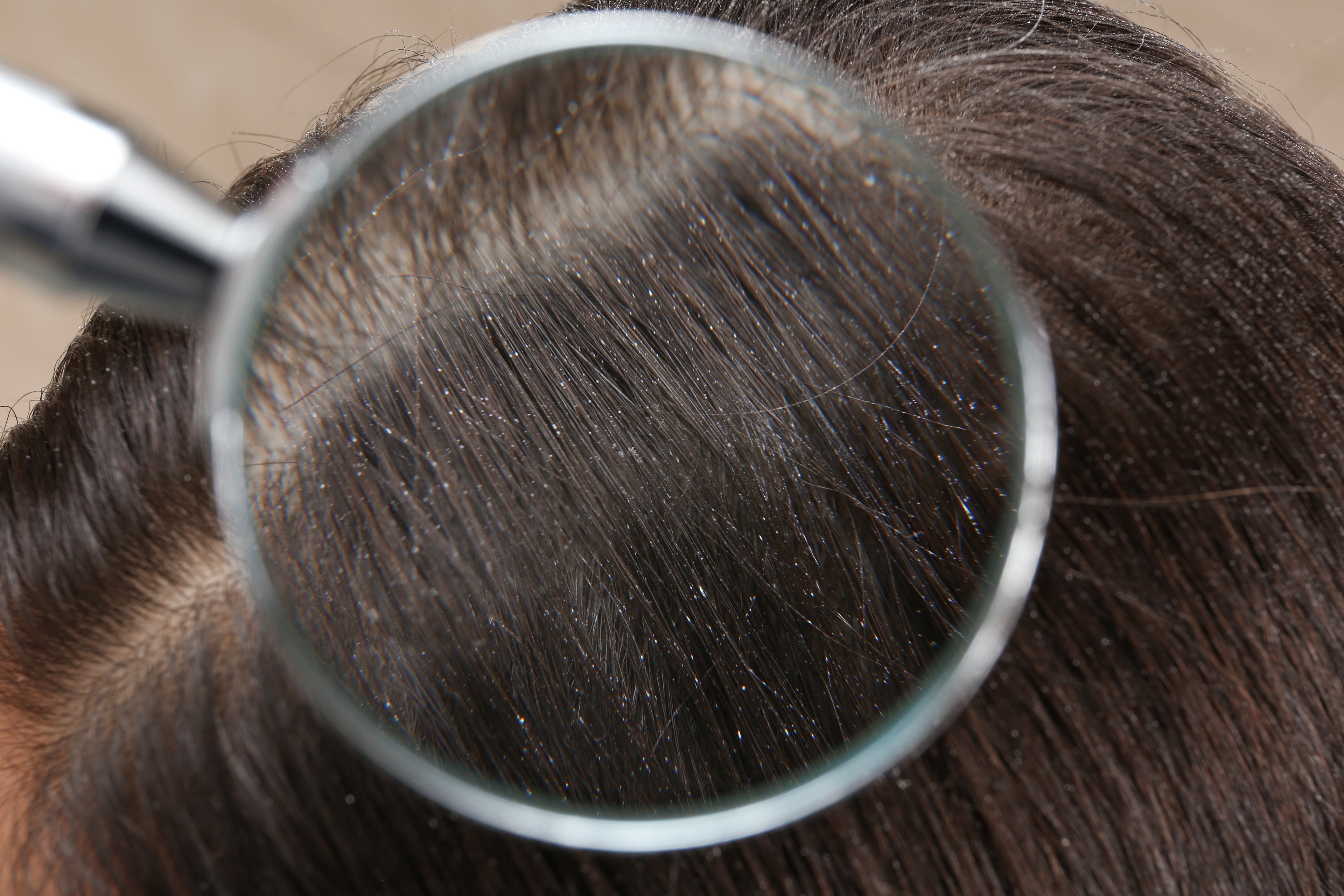 is it a dry scalp or eczema?