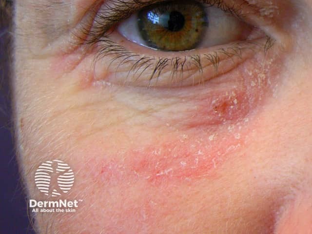dermatitis around the eye