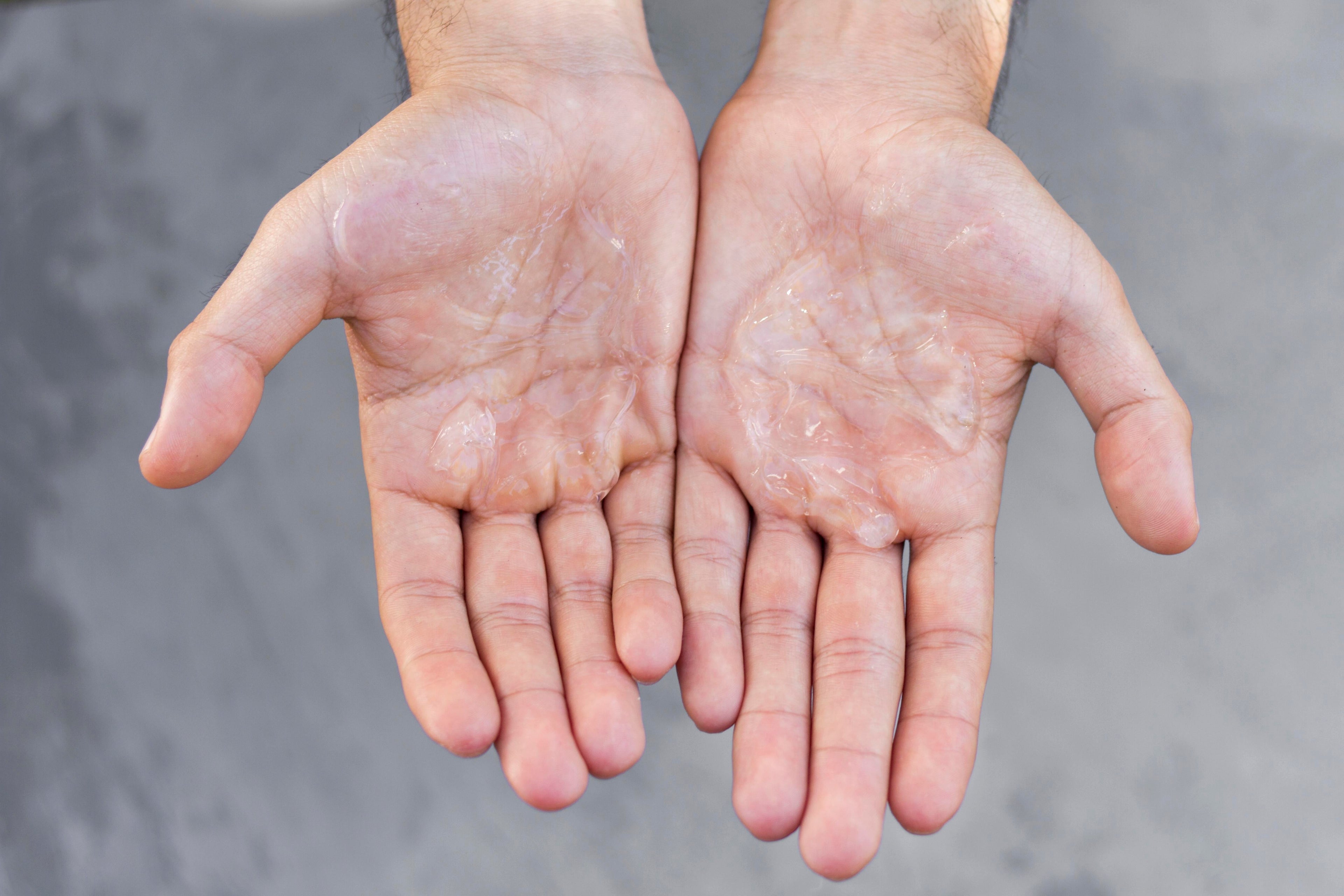 Eczema on Hands: Causes, Symptoms & How to Treat It