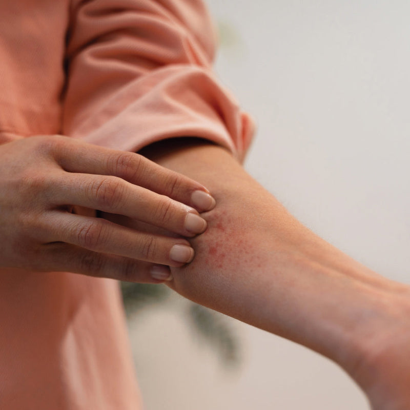 Why Does Eczema Itch So Much?