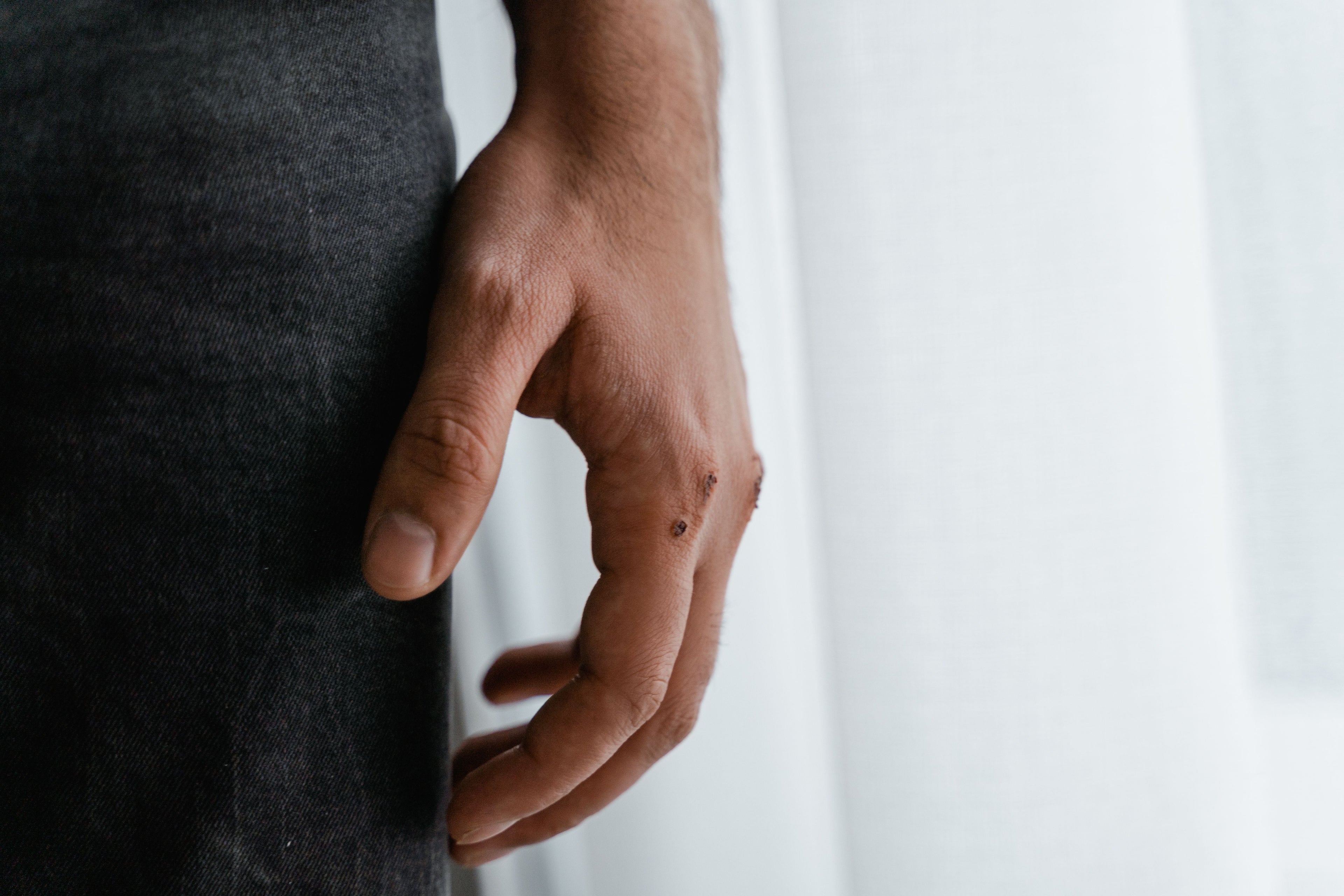 Dyshidrotic Eczema or Something Else How to Tell the Difference 