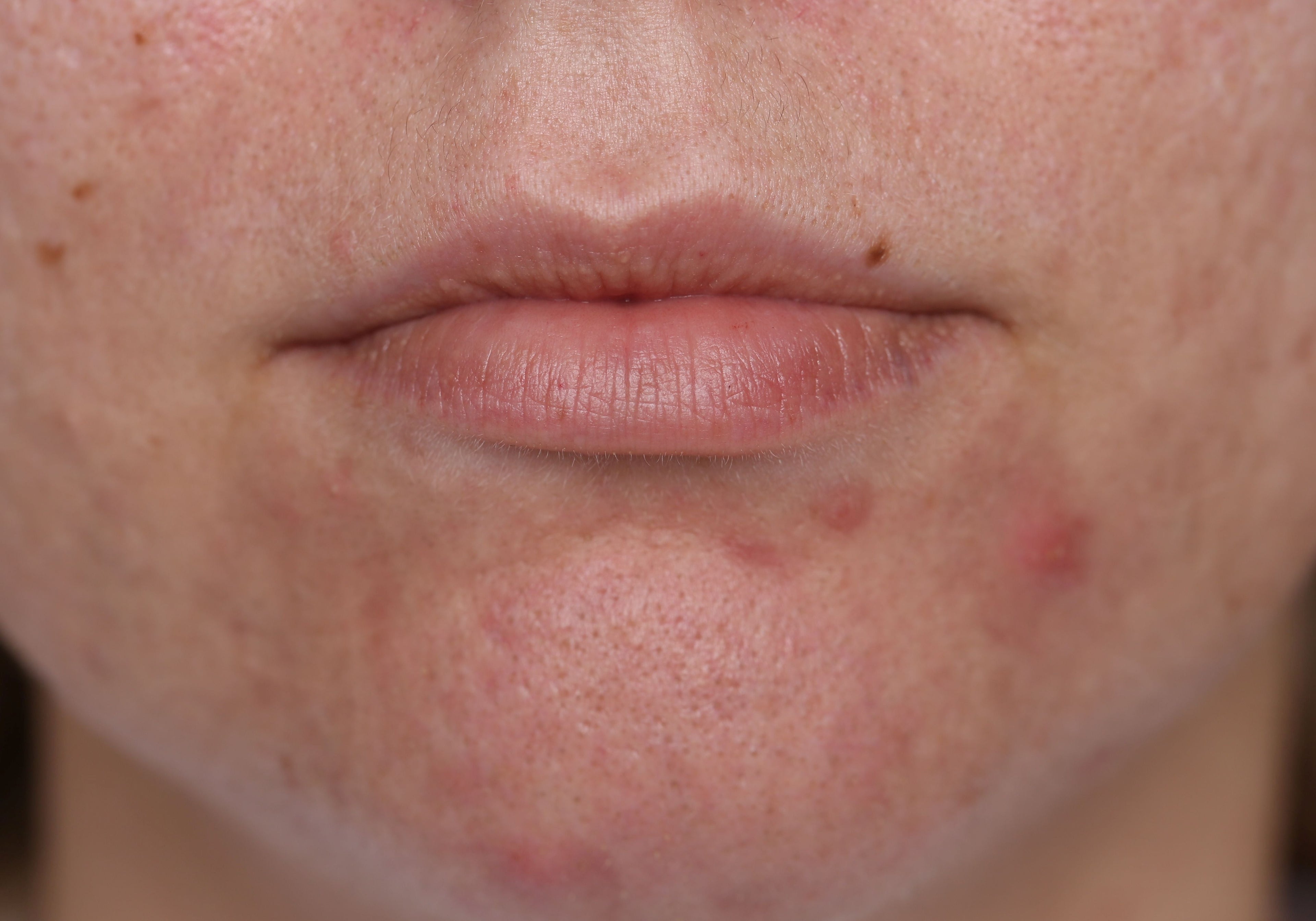 Photo of a lady with eczema on her chin