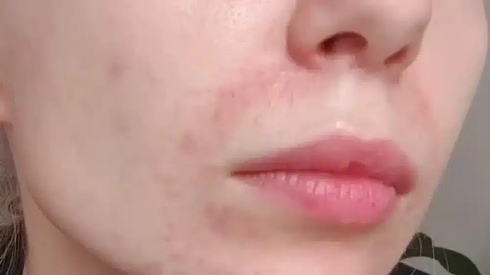 Dermatitis on Face: Causes, Symptoms & Treatment