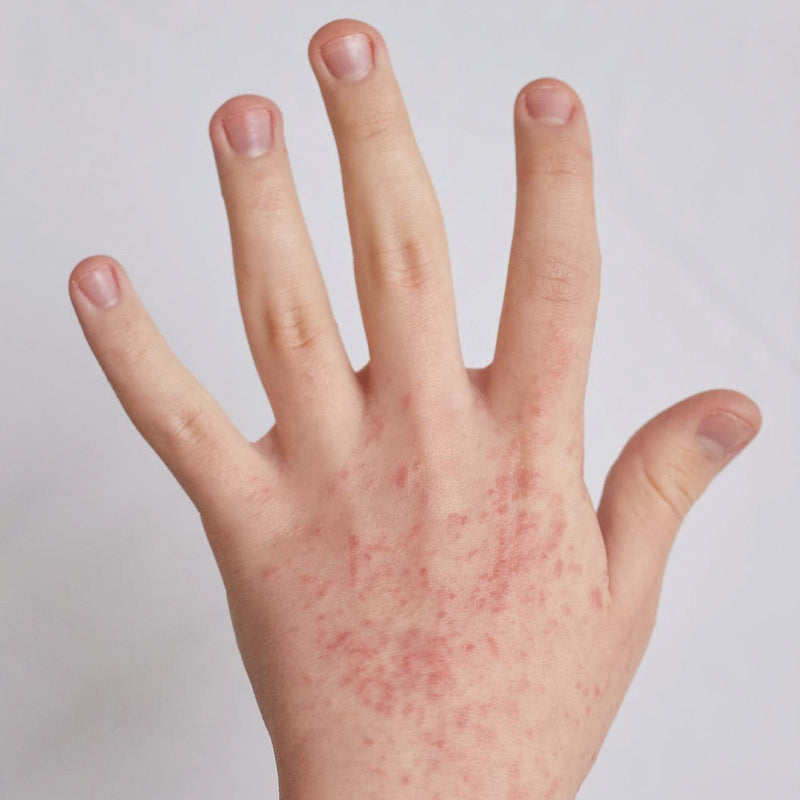 Dermatitis Causes: Why It Happens & What Triggers It