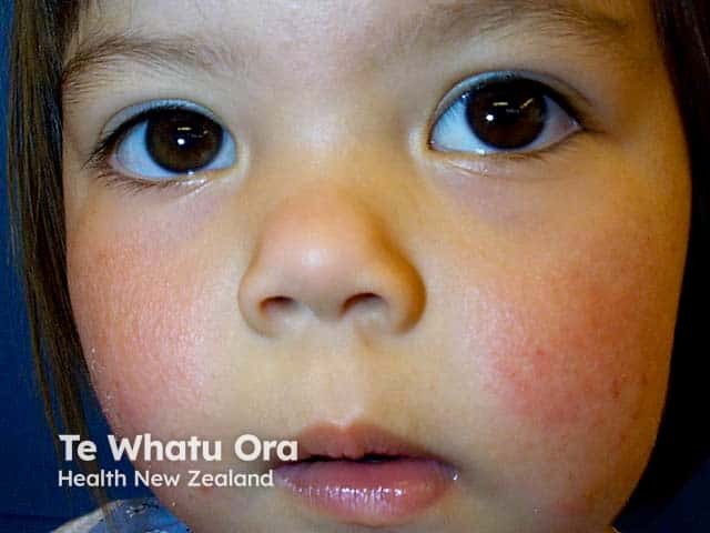 What Causes Facial Eczema?