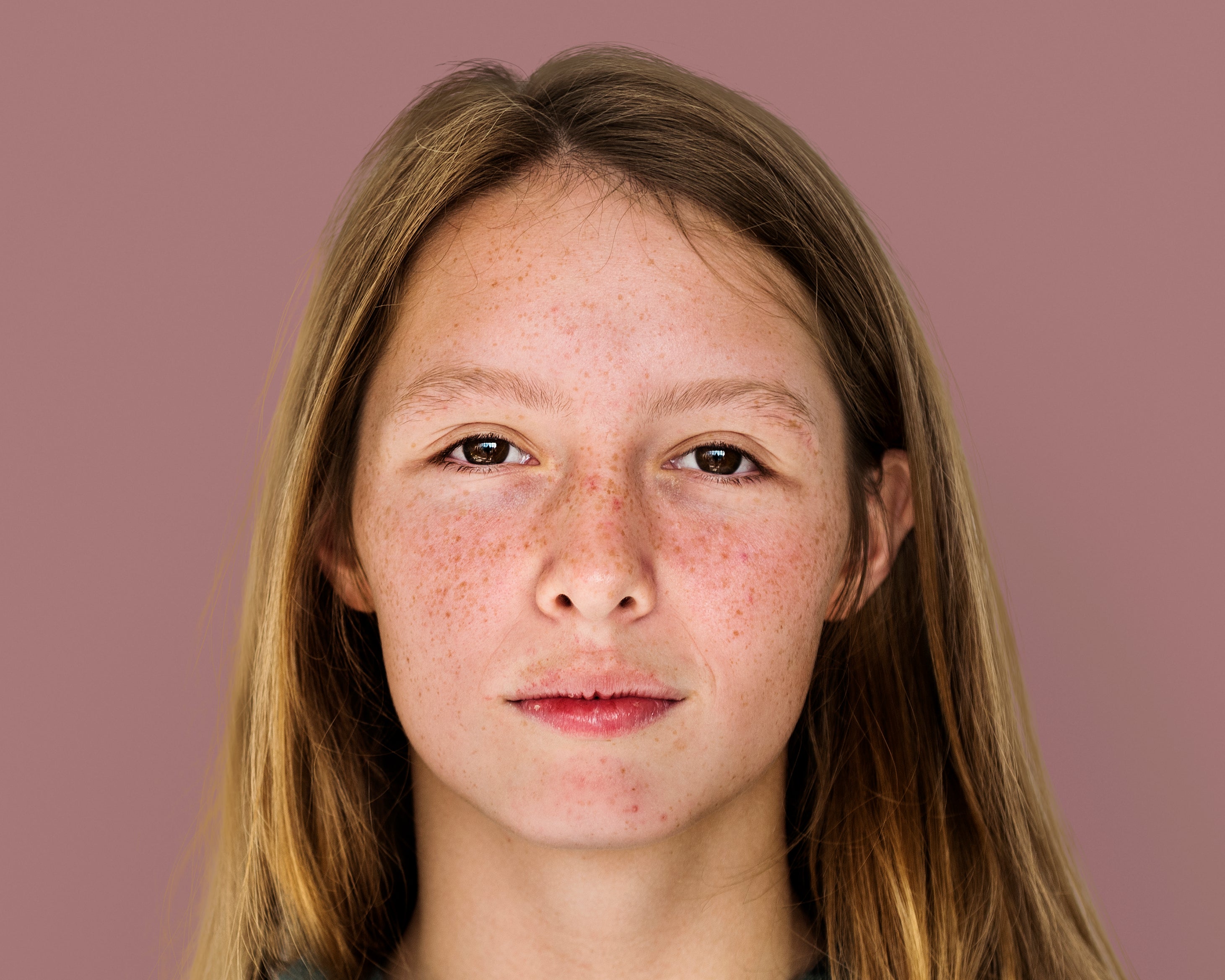 freckles and eczena on a young girl's face