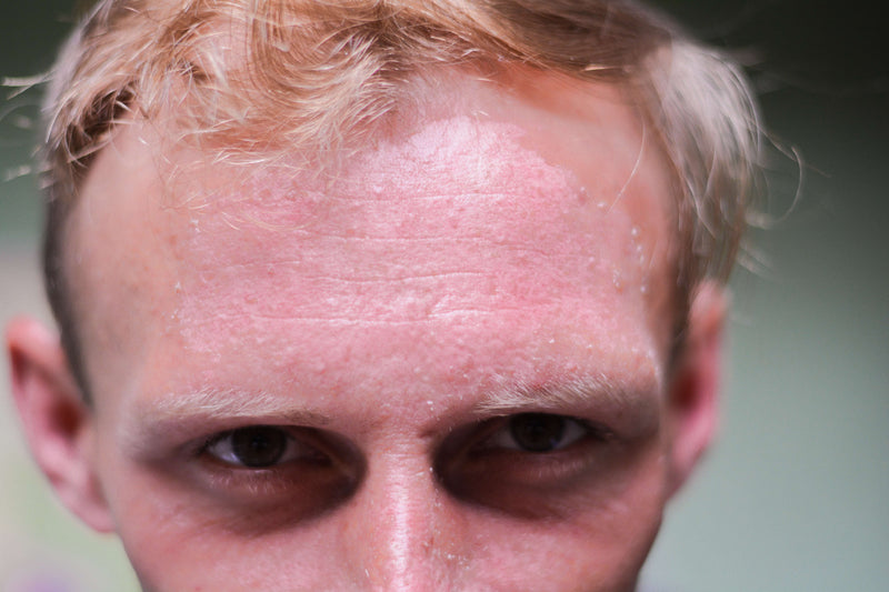 Forehead Eczema: Symptoms, Causes and Treatment