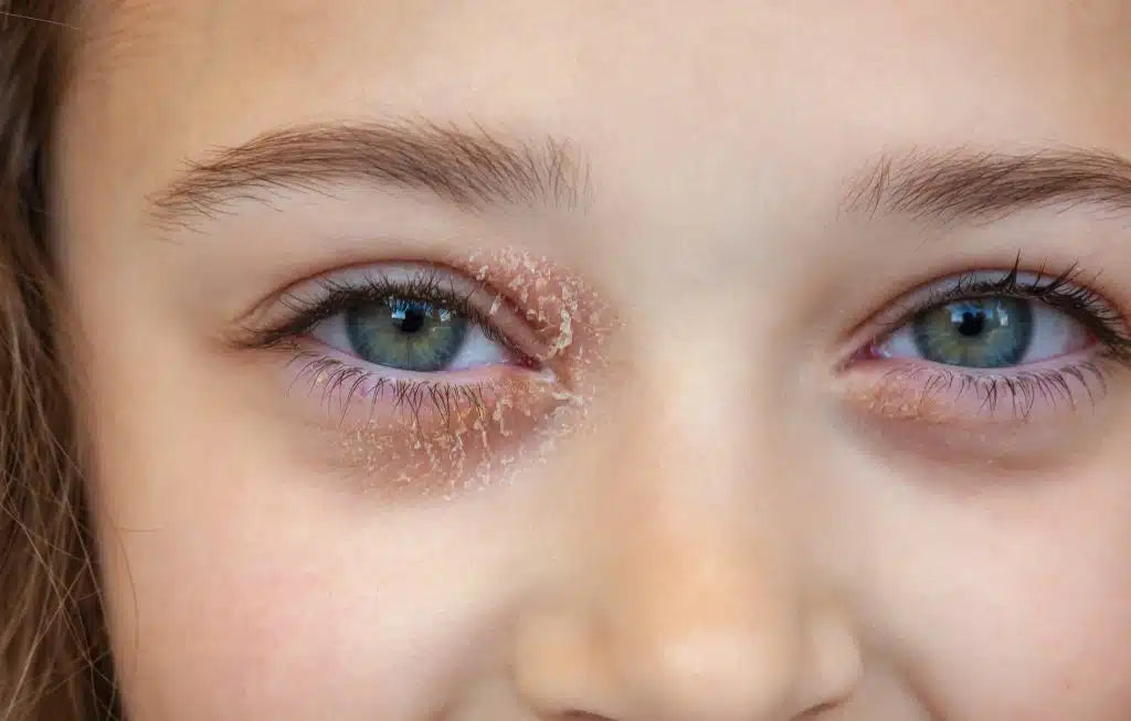 a girl with eczema on her eyelid
