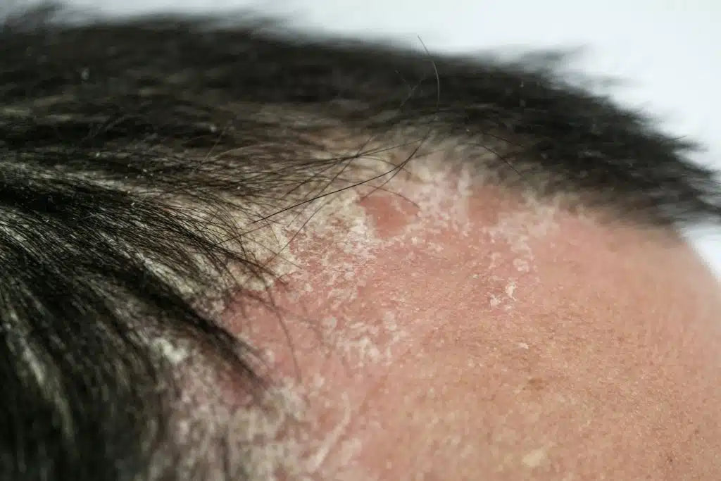 psoriasis on the head of a man