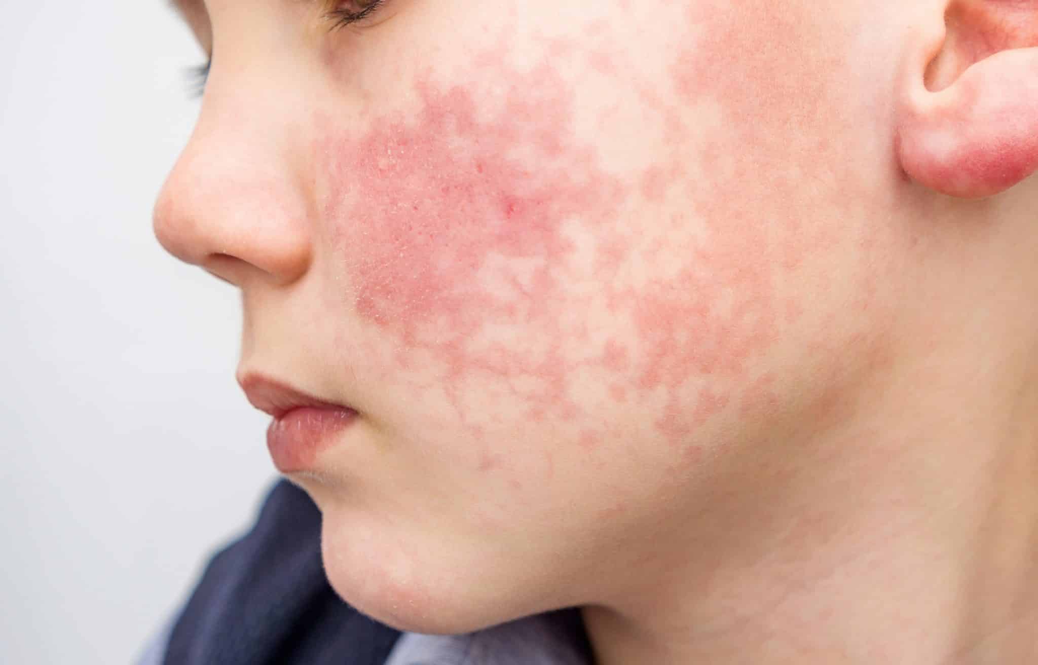 facial eczema
