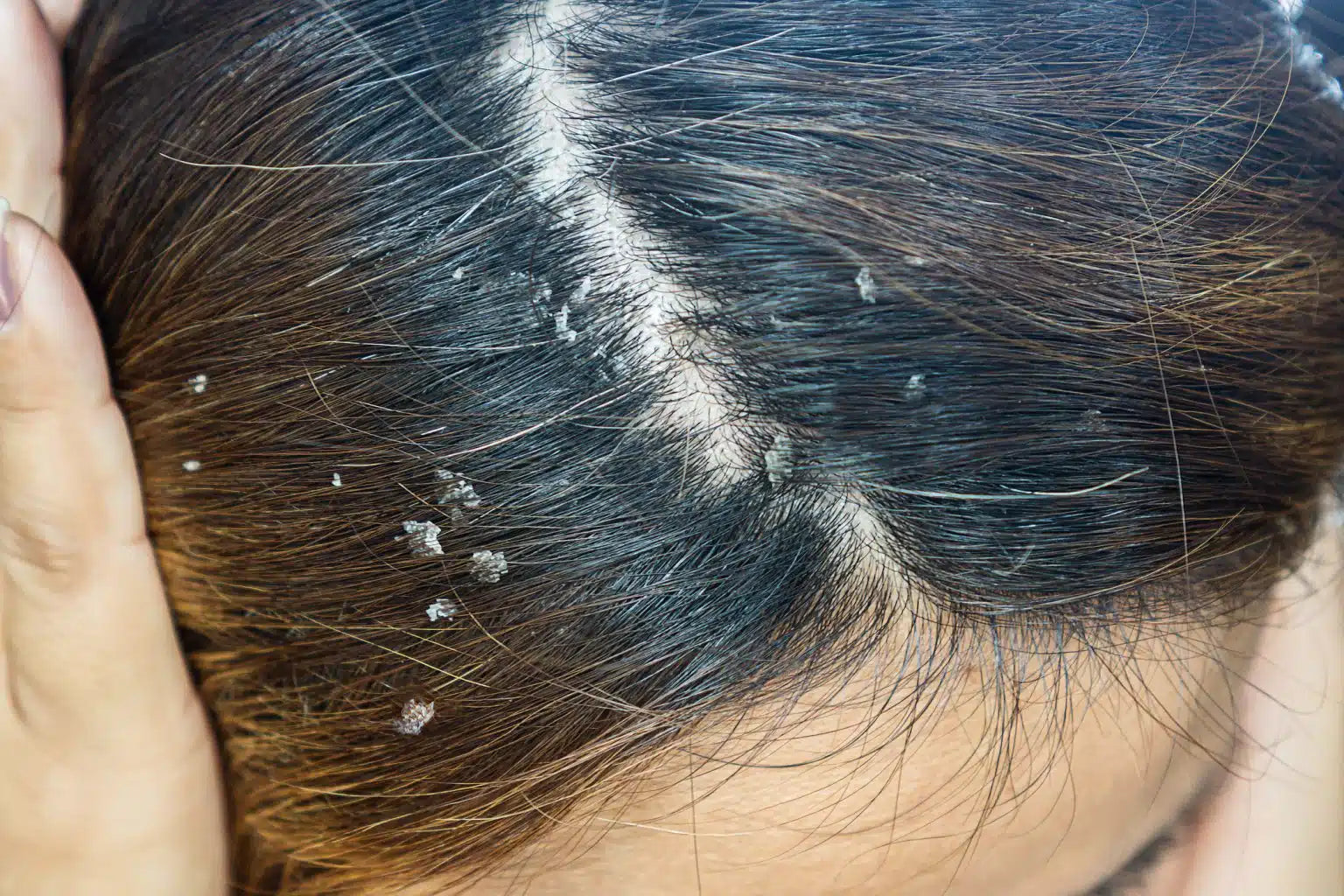 Eczema on a woman's scalp