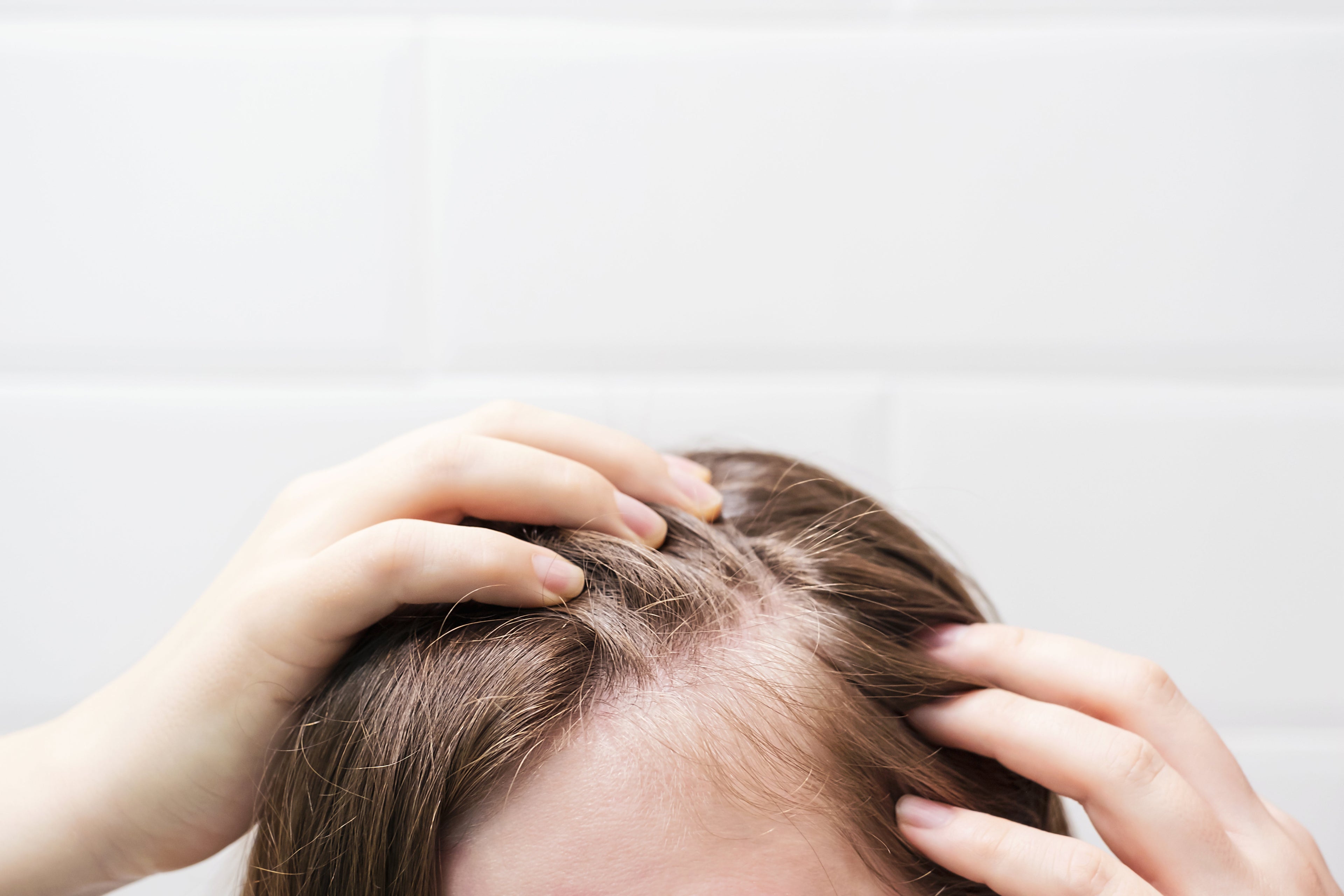 hair loss