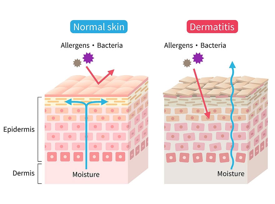 Dermatitis Treatment: How to Soothe, Repair and Protect Your Skin