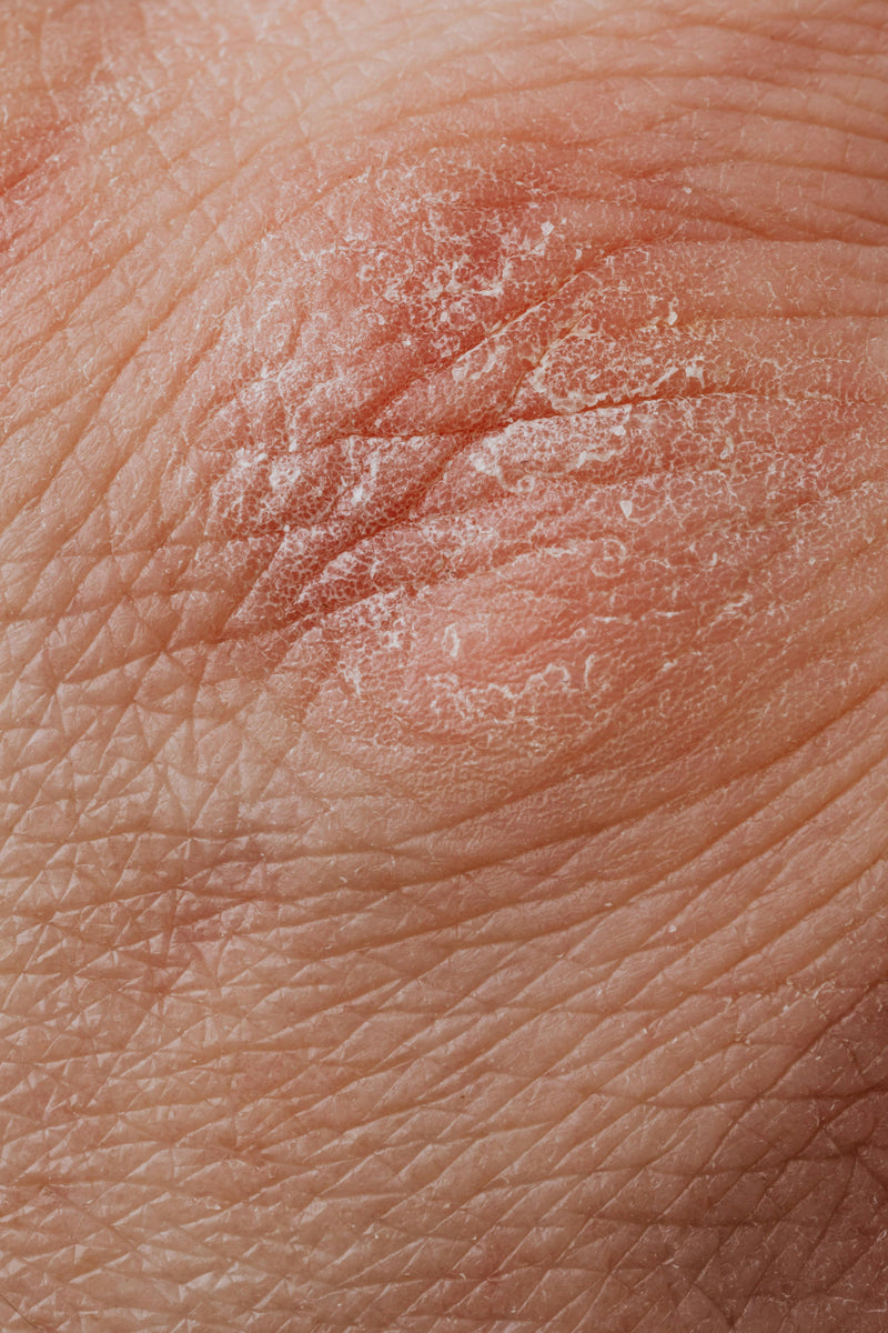 Seborrheic Dermatitis Treatment: A Complete Guide to Relief