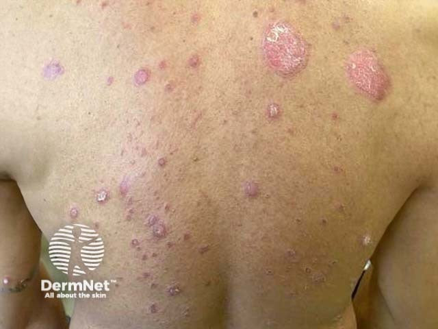 plaque psoriasis