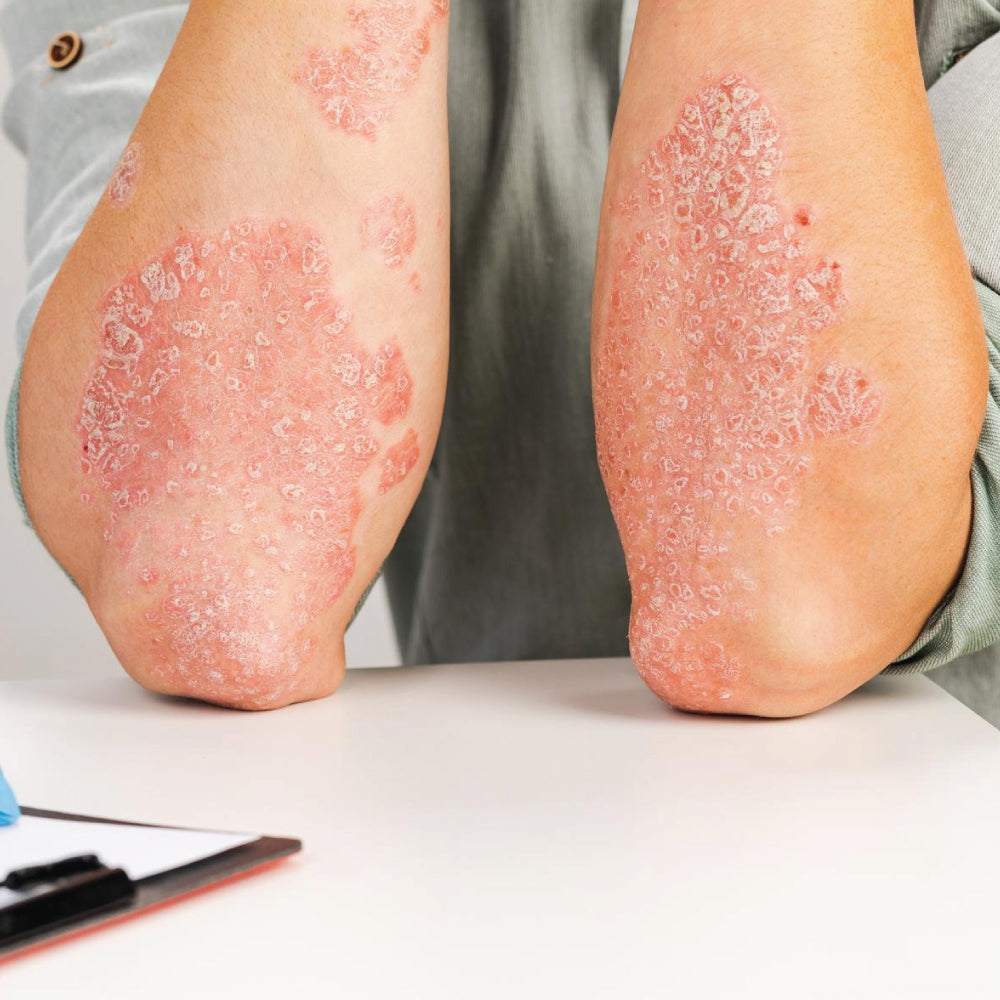 psoriasis on elbows 