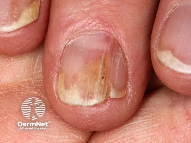 psoriasis on finger nails